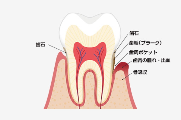 歯周病治療